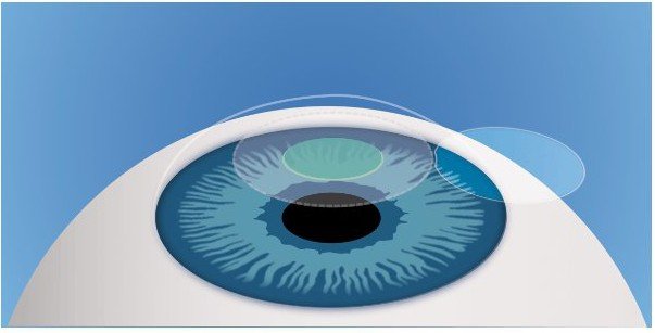The Allotex inlay in place over the pupil, with the corneal flap lifted.