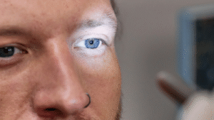 Where Does It Hurt in the Eye